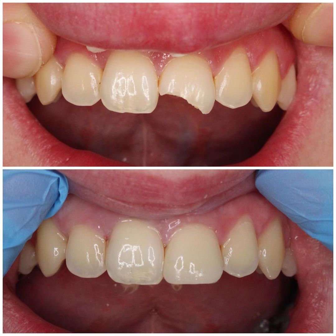 Restorations