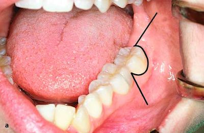 Extractions
