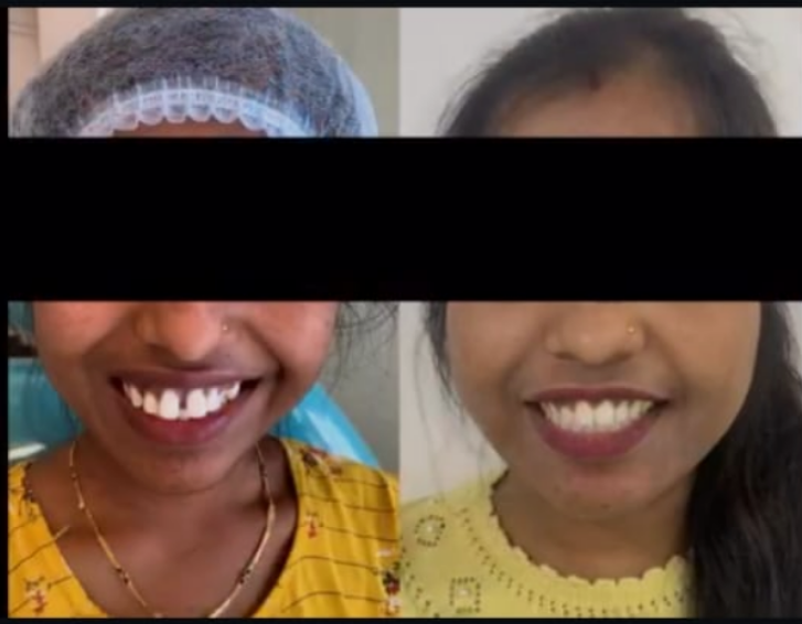 Smile Designing