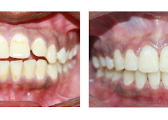 Before After Treatment